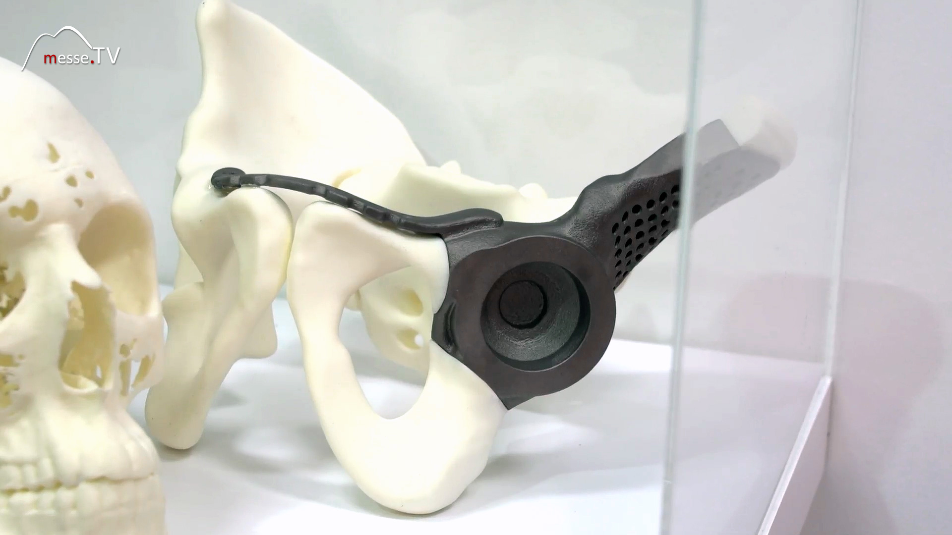 3D Druck Ersatzteil Knochen Titan Proto Labs