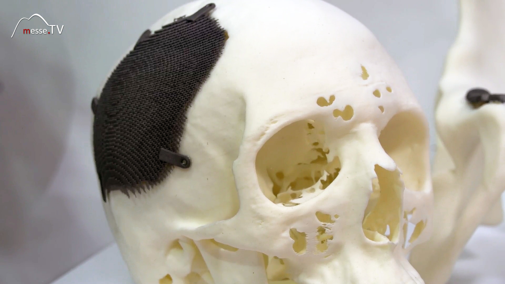 Proto Labs 3D printing medicine titanium implant human skull Hannover Fair